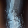 Distal Femoral Replacement in Young Adults with Traumatic Comminuted Distal Femur Fractures: A Report of Two Cases