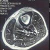 Primary Tuberculous Osteomyelitis of the Proximal Tibia Presenting as Chronic Osteomyelitis: A Diagnostic Challenge in Musculoskeletal Tuberculosis