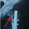 Management of a Missed Iatrogenic Fracture Neck of Femur in an Operated Case of Fracture Shaft Femur- Case Report