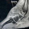 Beyond The Sprain, Unmasking a Rare Anterolateral Ankle Pathology in a Young Athlete