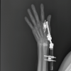 A Rare Case: Septic Arthritis of The Wrist