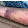 40-Year-Old Male with Medial Gastrocnemius Tear after Adderall (Amphetamine/Dextroamphetamine) Use: A Case Report