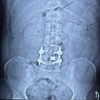 Cauda Equina Syndrome Following Posterior Interbody Cage Migration after TLIF: A Rare Case Report