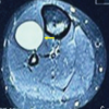 Schwannoma Arising from the Deep Peroneal Nerve: A Case Report