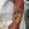 Necrotizing Fasciitis of the Forearm in a 68-Year-Old Patient Treated with Split-Thickness Skin Graft: A Case Report