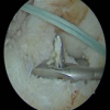 Functional Outcomes of Arthroscopic Anterior Cruciate Ligament Reconstruction Using Hamstring Tendon Autograft in a Predominantly Chronic Anterior Cruciate Ligament Injury Cohort: A Prospective Study