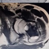 Aneurysmal Bone Cyst Presenting as a Pathological Subtrochanteric Femur Fracture in an Adolescent: A Case Report