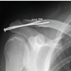 Chronic Acromioclavicular Joint Instability: Outcomes after Stabilization without Tendon Graft Augmentation