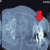 Neglected Bipolar Hemiarthroplasty Dislocation in a Young Adult with Superior Acetabular Wall Defect – A Case Report
