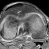 Transient Osteoporosis of Bilateral Knee Joints in Twin Pregnancy: A Case Report – A Valuable Addition to the Medical Literature