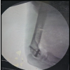 Isolated Humeral Trochlear Fracture without Associated Elbow Injury: A Rare Case Report