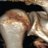 Shoulder Injuries Secondary to Proning: Sequelae of Long COVID Syndrome: A Case Report