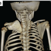 Sprengel Deformity Associated with Spondylocostal Dysostosis Treated Using a Modified Wilkinson Procedure: A Case Report