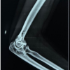 Functional and radiological outcome of capitellum fracture fixation with headless screws through lateral approach to elbow, a prospective observational study