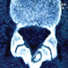 Navigation-Assisted Endoscopic Excision of Lumbar Vertebral Osteoid Osteoma: A Case Report