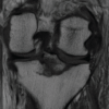 Direct Posterior Approach to Repairing Posterior Cruciate Ligament Tibial Avulsion Injury