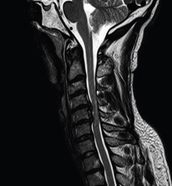 Figure 2: Pre-operative cervical magnetic resonance imaging. Sagittal image shows large herniated discs at C4-C5 and C5-C6, with severe spinal cord compression and T2 signal change.