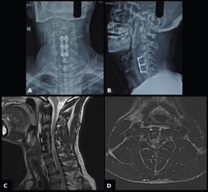 Figure 3: Anteroposterior (a) and lateral (b) cervical radiographs show the anterior cervical plate and interbody graft/cage construct spanning C4-C6 in satisfactory position, with maintained cervical alignment and no evidence of hardware failure or graft subsidence. Sagittal (c) and axial (d) Magnetic resonance imaging images show T2 hyperintensity in the right hemicord at the C4-C5 level.