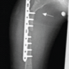 Repeated Surgeries and Clinical Assessment Using 3D Gait Analysis in Unilateral Congenital Short Femur: A Case Report