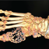 A Rare Case of Giant Cell Tumor of the First Metatarsal: En Bloc Resection and Fibular Autograft Reconstruction