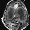 Pseudoaneurysm of the Medial Genicular Artery as a Rare Cause of Recurrent Knee Swelling – A Case Report