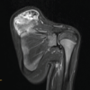 Posterior Scapular Osteochondroma in a Pediatric Patient: An Uncommon Presentation of a Common Benign Tumor