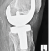 Lipoma Arborescens of the Knee: An Intraoperative Mimicker of Pigmented Villonodular Synovitis in Bilateral Knee Osteoarthritis – A Case Report