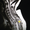 Surgical Management of Pott’s Paraplegia in a 27-Week Pregnant Woman with Continuation of Pregnancy: A Case Report