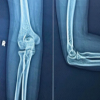 Management of a Post-traumatic Stiff Elbow: A Case Report