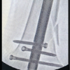 Retrograde Nailing of an Unstable Distal-Third Femoral Shaft Fracture Using Pure Indirect Reduction: A Case Report in Osteoporotic Bone