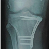Management of a Rare Combined Osseoligamentous Knee Injury: Tibial Plateau Fracture with High-Grade Posterior Cruciate Ligament Tear Treated by Arthroscopic Reconstruction and Osteosynthesis – A Case Report