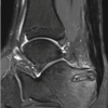 Surgical Treatment of Anchor-induced Heel Pain after Minimally Invasive Repair of Acute Achilles Tendon Rupture Using Percutaneous Achilles Repair System Achilles Midsubstance SpeedBridge™ Repair: A Case Report