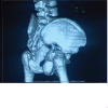 A Case Report on Unclassified Anatomical Sciatic Nerve Variant in Acetabulum Fracture