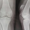 Case of Chronic Neglected Patellar Tendon Rupture Reconstruction Using Semitendinosus and Gracilis Tendon Autologous Graft