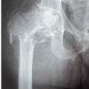Management of Subtrochanteric Femur Fracture with Pre-existing Grade IV Psoriatic Hip Arthritis Using Primary Total Hip Arthroplasty with a Long Distal-Loading Stem: A Case Report