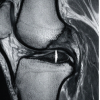 Functional Recovery after Arthroscopic Management of Meniscal Tears