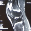 Deformed Patella after an Acute Traumatic Quadriceps Rupture in an Adolescent Male Treated With Primary Open Repair: A Rare Case Report