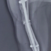 Twenty-year Delayed Failure of an Intramedullary Humeral Nail Due to Shaft Non-union and its Surgical Management: A Case Report