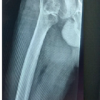 Uncoupling of the Helical Blade in a Proximal Femoral Nail – A Novel Mechanical Failure