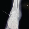 Cedell’s Fracture of the Talus Managed with Herbert Screw Fixation through Posteromedial Approach – A Case Report