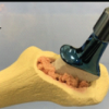Short-term Outcomes of Impaction Bone Grafting Technique with a Collared Fully Hydroxyapatite-Coated Stem in Revision Total Hip Arthroplasty: A Case Series