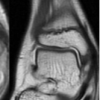 Chronic Pediatric Ankle Swelling Due to an Occult Foreign Body: A Case Report