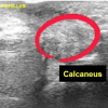 Segmental Achilles Tendon Loss With Skin Defect in an Open Calcaneal Fracture Managed Without Tendon Reconstruction: A Case Report