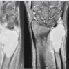 Journey and Roadblocks in the Management of Aneurysmal Bone Cysts in Patients with Unusual Presentations