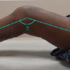 Stepwise Surgical Correction of Fixed Flexion Deformity in Total Knee Arthroplasty: Functional Outcomes