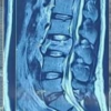 Traumatic Durotomy with Entrapment of Nerve Roots in a Lumbar Burst Fracture Diagnosed Intraoperatively: A Case Report