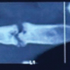 Rare Presentation of Thoracic Outlet Syndrome with First Rib Fracture – Case Report