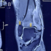 Low-grade Central Osteosarcoma with High-grade Transformation in the Distal Tibia: A Rare Case Report