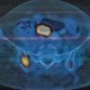 Understanding Diagnostic Challenges in Ewing Sarcoma – A Report of Two Cases