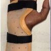 Neglected but Negotiated – A Case Report of Multiple Zone VII Extensor Tendon Injuries Reconstructed Using Fascia Lata Autograft